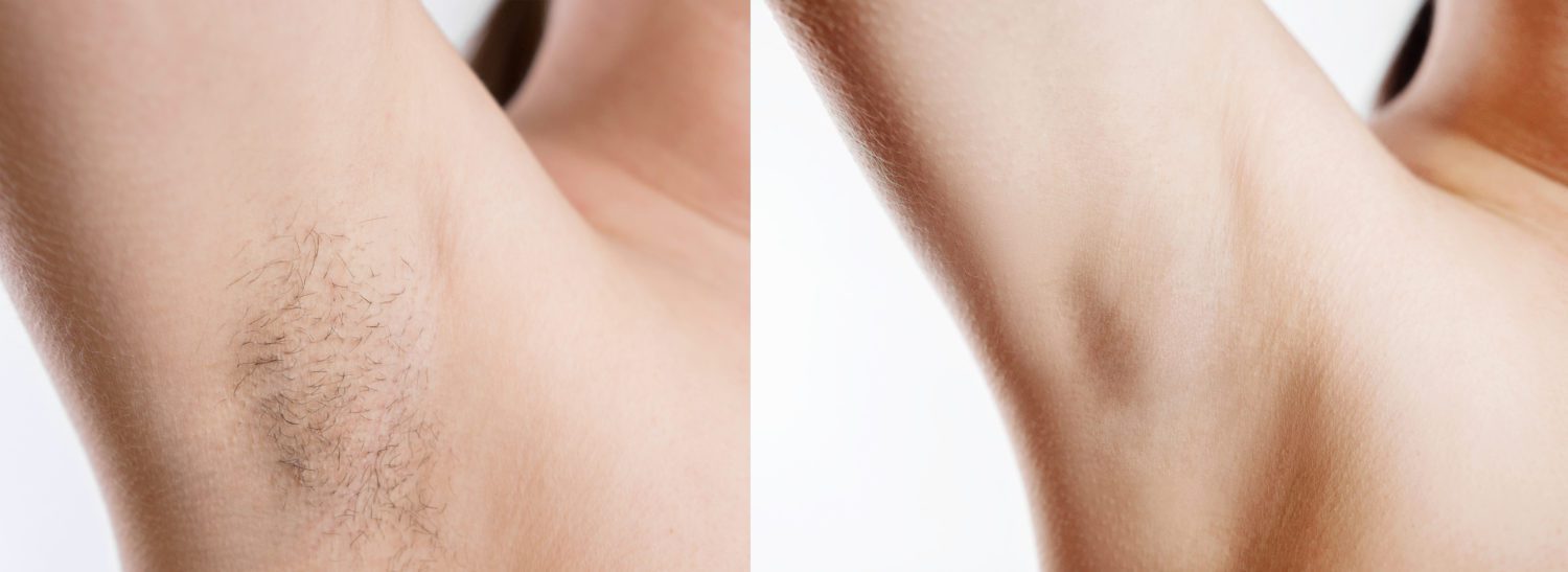 Laser Hair Removal armpits