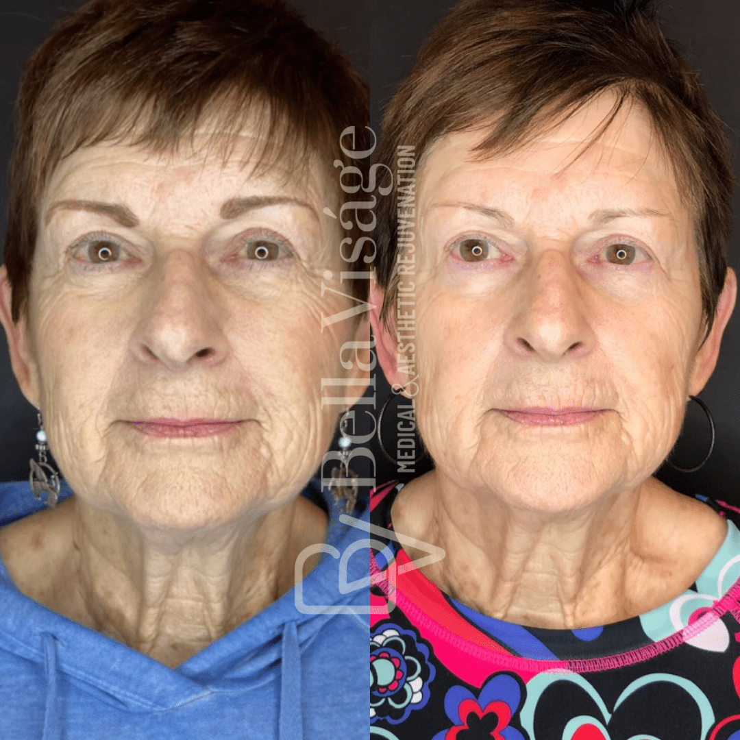 Tattoo removal in Lakeland Veterans