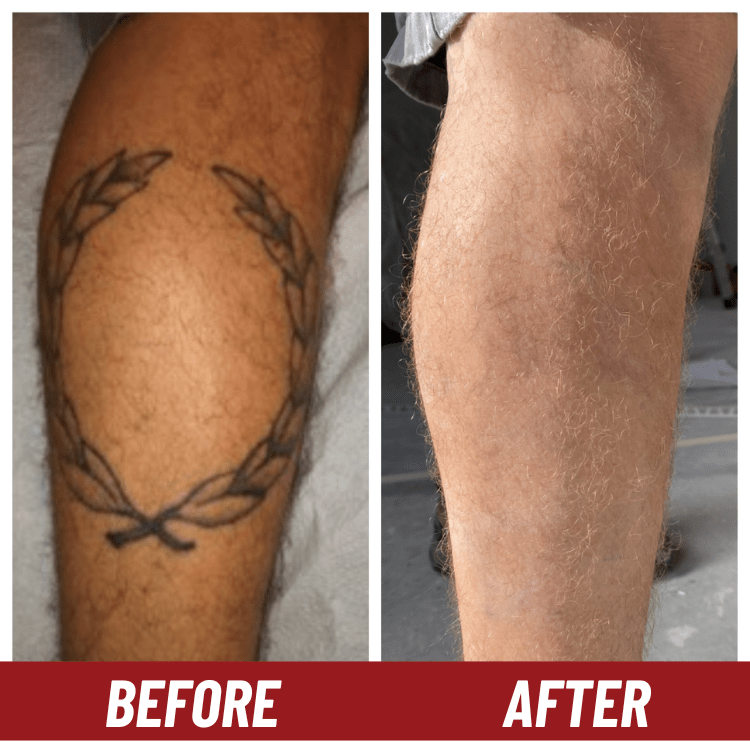 Tattoo removal in Lakeland before and after