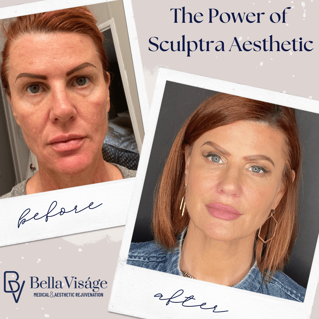 before and after Sculptra Skin Revitalization