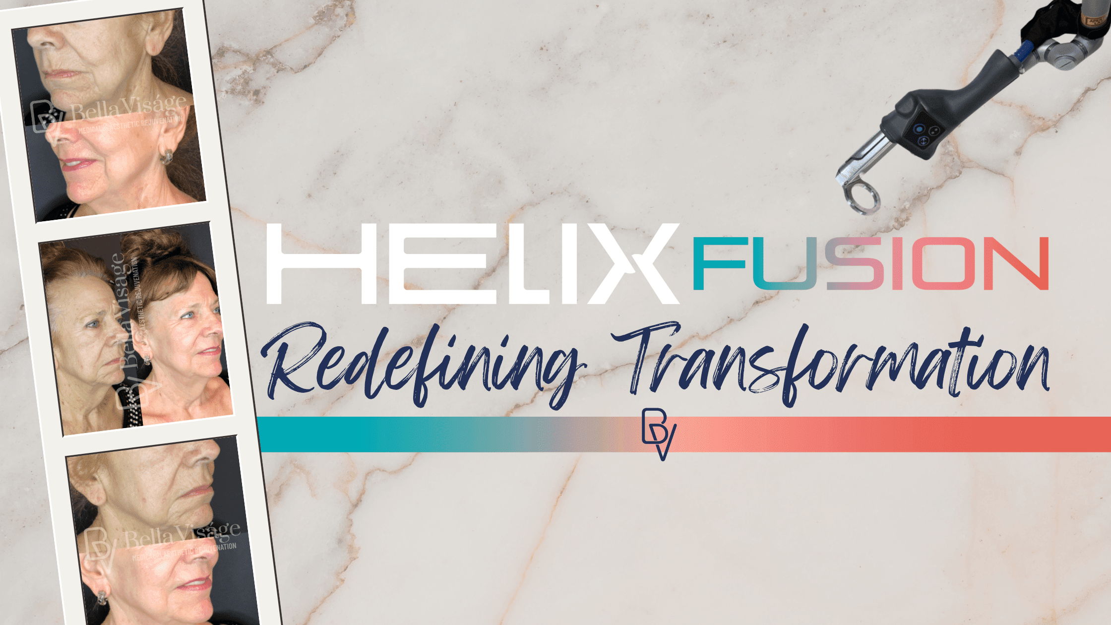 Laser Tattoo removal in Lakeland