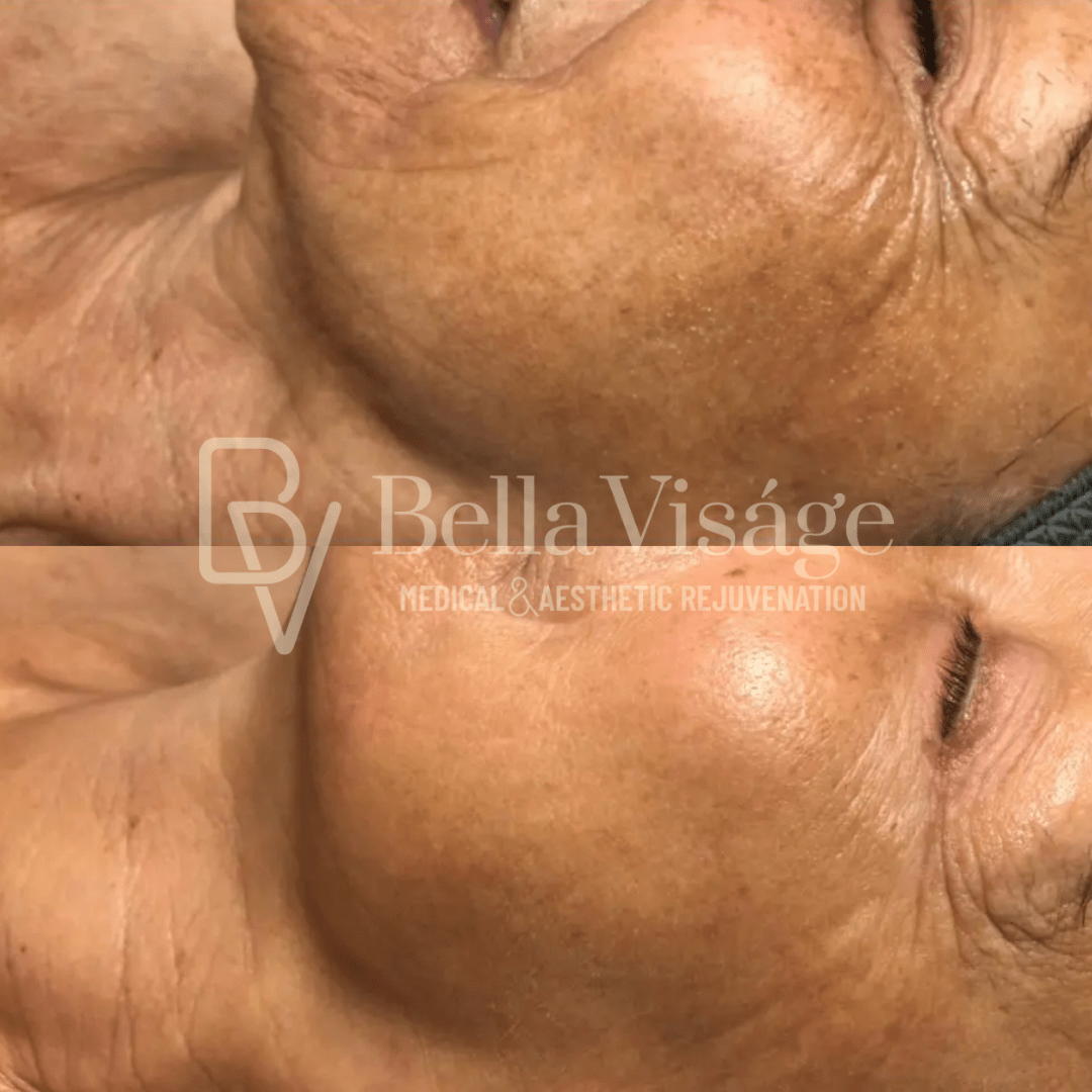 Tattoo removal in Lakeland Veterans