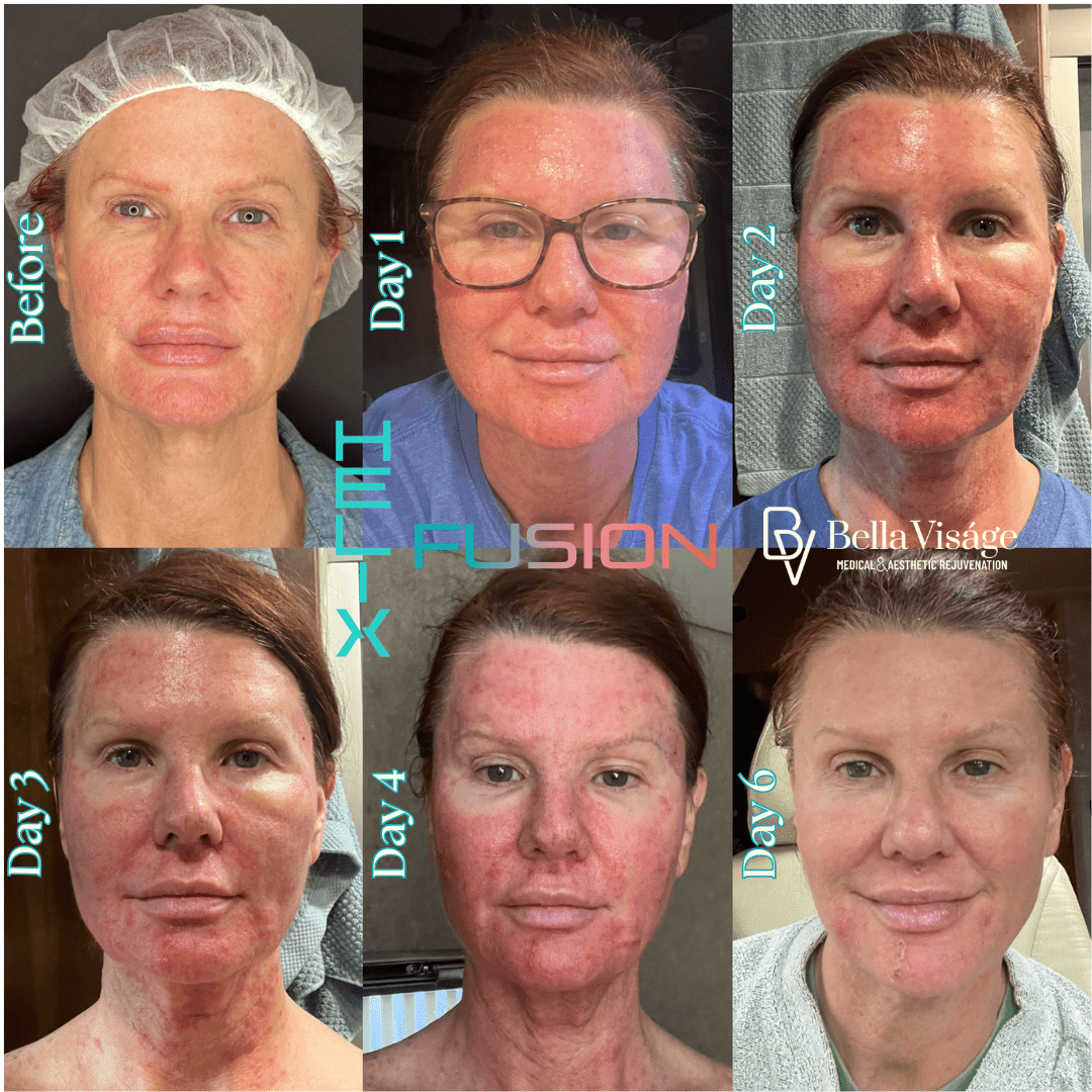 Tattoo removal in Lakeland Veterans