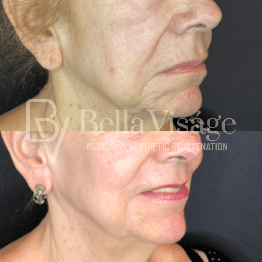 Tattoo removal in Lakeland before and after