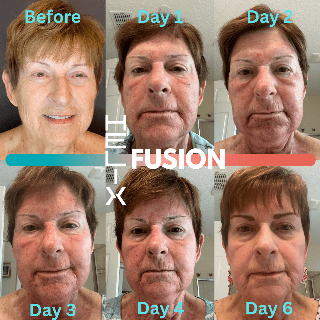 Tattoo removal in Lakeland Veterans