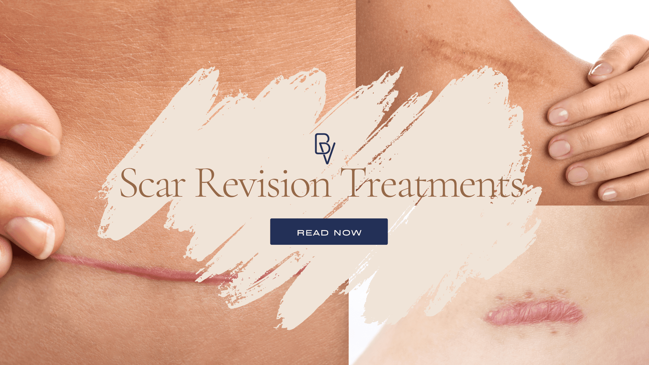 Laser Tattoo removal in Lakeland